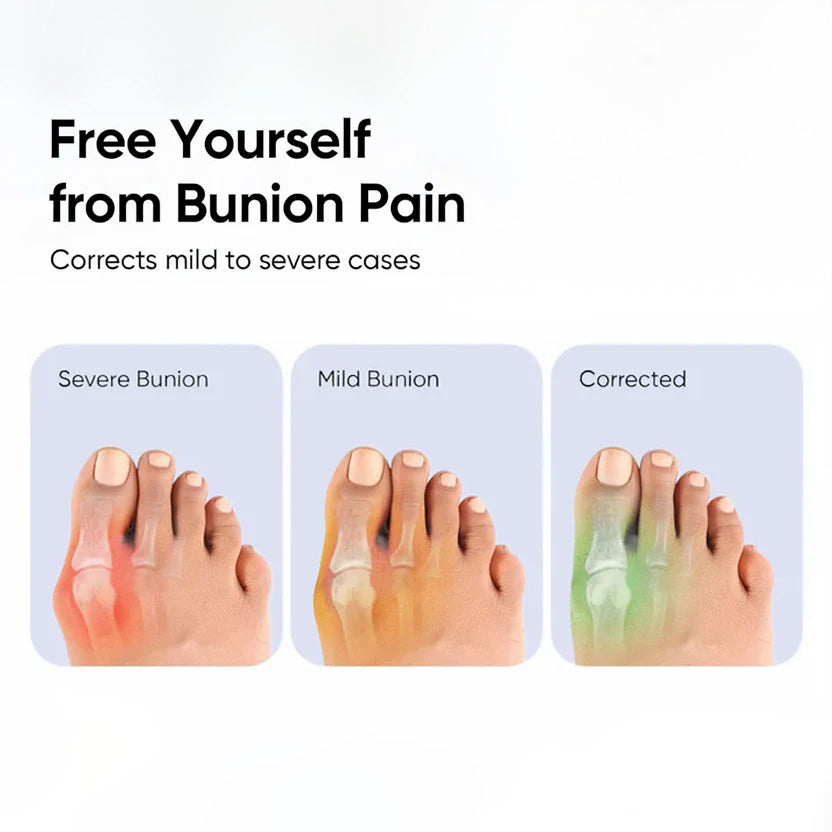 Bunion Corrector Splint Kit For Toe