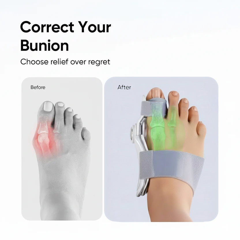 Bunion Corrector Splint Kit For Toe